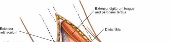 Illustration 98 for Optimized Approaches to the Dorsum of the Foot & Ankle