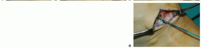 Illustration 22 for Restore Movement: Tendon Transfer for Common Peroneal Nerve Foot Drop