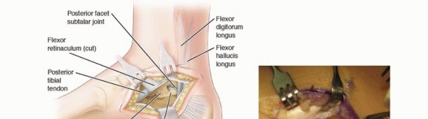 Excision of Talocalcaneal: Solving Rigid Flatfoot Pain