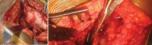 Illustration 32 for Total Hip Arthroplasty: Restoring Mobility in Juvenile Idiopathic Arthritis