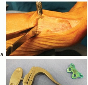 Proximal Opening Wedge: Effective Hallux Valgus Correction