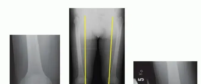 صورة توضيحية لـ جراحة تقويم الركبة (قطع العظم الظنبوبي العالي): حل دائم لآلام الركبة في اليمن والخليج