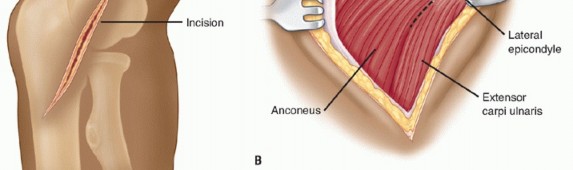 Illustration 50 for Surgical Approaches to Shoulder & Elbow: Pearls and Pitfalls