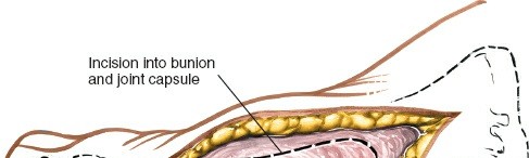 Illustration 201 for Optimized Approaches to the Dorsum of the Foot & Ankle
