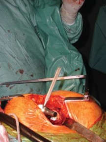 Illustration 28 for S-ROM: Inside the Technique of Modular Implant Design