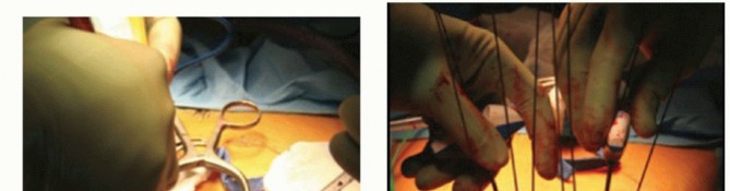 Percutaneous Pedicle Screw: Minimally Invasive Trauma Fixation