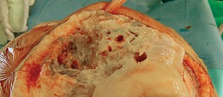 صورة طبية: مراجعة استبدال الركبة الجزئي الفاشل دليلك الشامل للعلاج الناجح في صنعاء