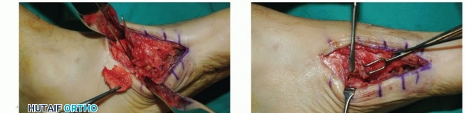 Illustration 78 for Mastering Midfoot Arthrodesis: Protect the Deep Neurovascular Bundle