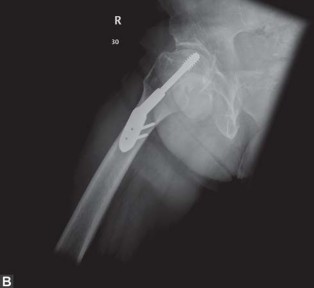Illustration 6 for Optimal Arthroplasty in Proximal Fractures: What You Need to Know