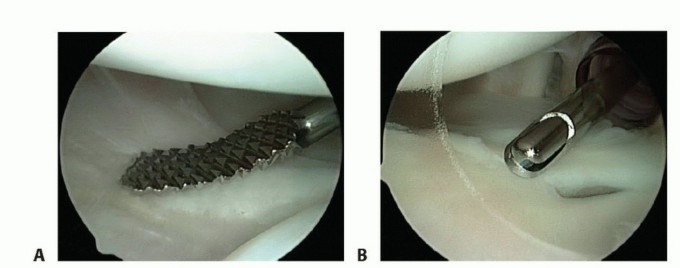 Illustration 2 for Relief for MDI: Expert Treatment of Multidirectional Shoulder Instability