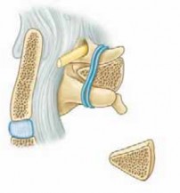 Illustration 24 for Cervical Fusion: The Line is Drawn for Lasting Stability