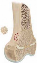 Excision of Physeal Bar: Preventing Limb Deformity & Discrepancy