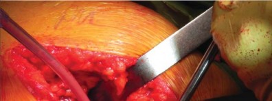 Illustration 27 for Unlock better THA: The technique of short stem for less invasiveness