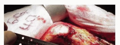 Illustration 7 for Cemented Total Hip: A Successful & Evidence-Based Solution