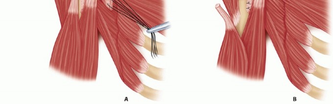 Illustration 20 for Irreparable Subscapularis Tears? Explore Pectoralis Major Transfer.