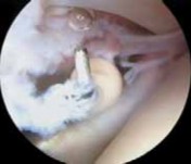 Illustration 15 for Capsular Releases for Loss of Motion: Restore Your Shoulder