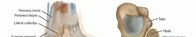 صورة توضيحية لـ أوتار الكاحل المنزلقة (الشظية): دليلك الشامل للتشخيص والعلاج والتعافي مع الدكتور محمد هطيف