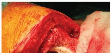 Illustration 27 for Why Polished Tapered Cemented Stems Excel in Hip Replacement