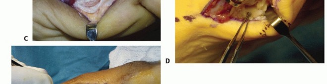 Illustration 20 for Restore Your Foot: Surgical Treatment for Hallux MP Joint Turf Toe