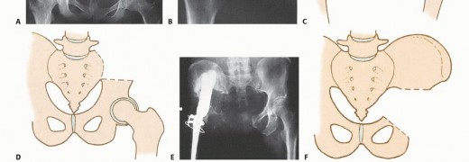 Illustration 15 for Surgical Pelvic Resection: Gluteus Maximus Muscle & Nerve Preservation