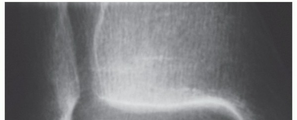 Lesions of the Talus: Is Microfracture the Answer for You?