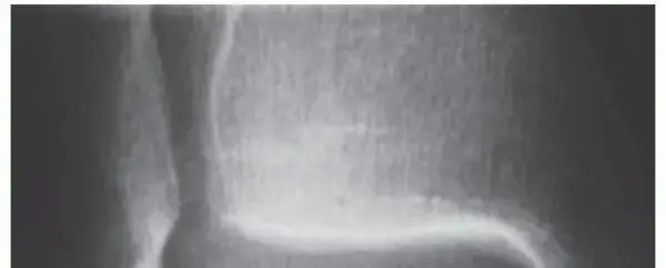 صورة توضيحية لـ انفصال الغضروف العظمي في الكاحل: دليلك الشامل لاستعادة الحركة والعلاج مع الأستاذ الدكتور محمد هطيف