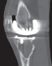 Illustration 8 for Porous Metal Cones: Biologic Fixation for Severe Bone Loss