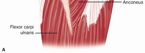 Illustration 35 for Surgical Approaches to Shoulder & Elbow: Pearls and Pitfalls