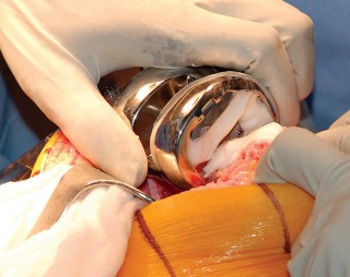 Illustration 59 for Mastering Gap Balancing in Revision TKA: Avoid Common Pitfalls