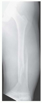 Illustration of screw is inserted - Dr. Mohammed Hutaif