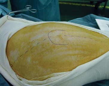 Illustration 37 for Navigating Early THA for Fractures of the Acetabulum