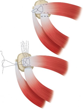 Illustration 19 for Acad Orthop Surg Challenge: Diagnose Shoulder Pain Case 1