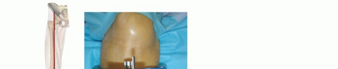 Illustration 11 for HINTEGRA Total Ankle: Unlocking Natural Ankle Movement