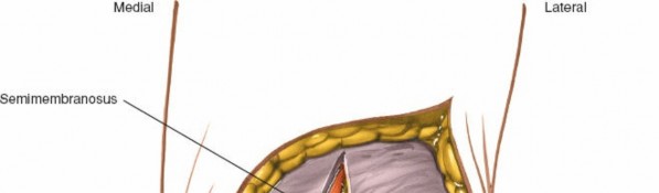 Illustration 180 for Mastering Knee Approaches: Spotlight on Superficial Medial Ligament