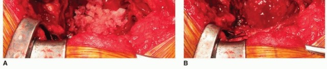 Illustration 25 for Uncemented Acetabular Revision: Optimizing Hemispherical Cup Use