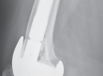 Illustration 74 for Mastering Gap Balancing in Revision TKA: Avoid Common Pitfalls