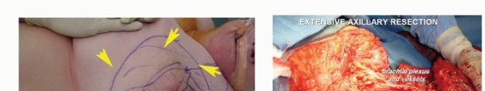 Illustration 24 for Axillary Space Exploration: Surgical Resection of Complex Tumors