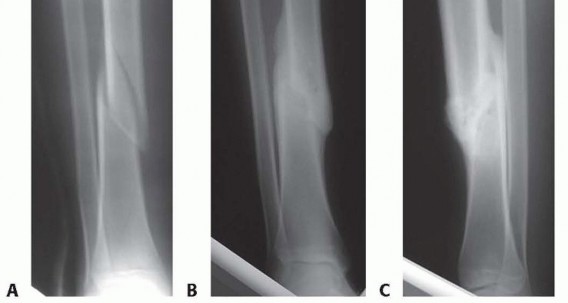 Illustration 5 for Optimizing Intramedullary Nailing for Tibial Shaft Fractures