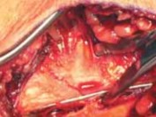 Illustration 36 for Optimal Fixation of the Ankle: Open Reduction & Internal Fixation