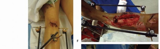 Illustration 52 for Tibia External Fixation: See How Pins Are Placed for Healing