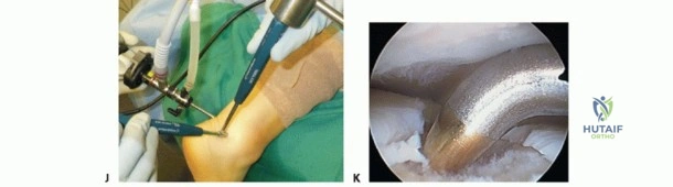 ABOS/AAOS Orthopaedic Review: Posterior Malleolus, Pilon & Calcaneal Fractures | Part 21568