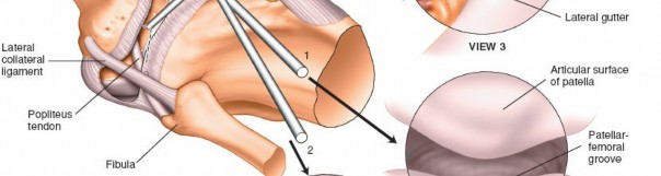 Illustration 9 for Mastering Knee Arthroscopy Approaches: Safely Withdraw the Arthroscope