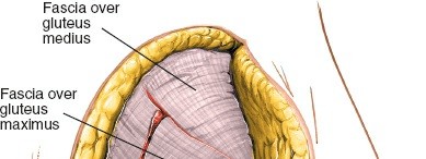Illustration 37 for Pelvis & Acetabulum Approaches: Unlocking the Posterior Superior Iliac