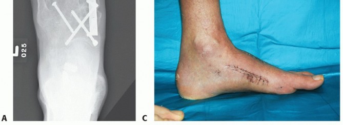 Illustration 83 for Mastering Midfoot Arthrodesis: Protect the Deep Neurovascular Bundle
