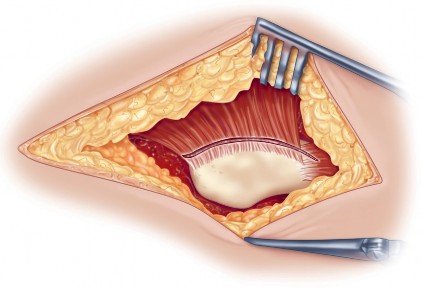 Illustration 27 for Direct Lateral Hip: Optimize Exposure with Sharp Curved Hohmann