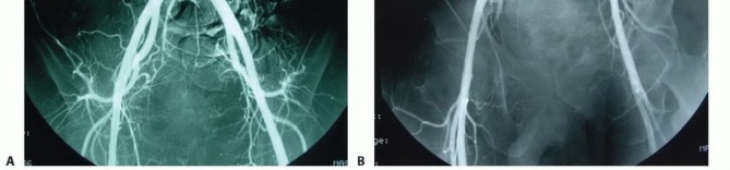 Illustration 21 for Sacral Tumor Surgery: Safeguarding Bowel & Bladder Control