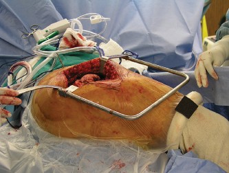 Illustration 4 for Mastering Direct Lateral Exposure for Revision Total Hip Success