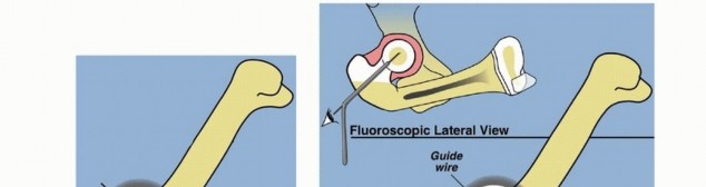 Illustration 23 for Treatment for Congenital Femoral Deficiency: What You Need to Know