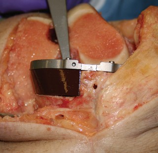 Illustration 10 for Understand Augments: The Role of Metal Augments in Arthroplasty