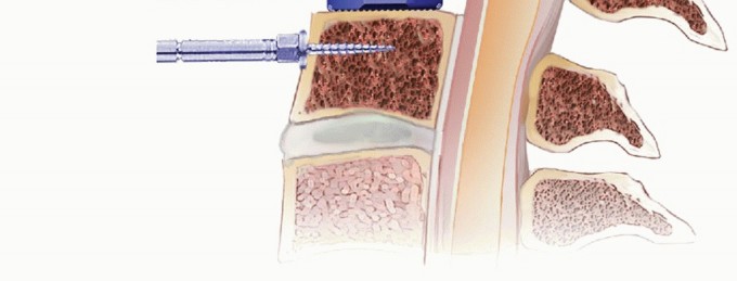 Illustration 22 for How ACDF Clears Your Posterior Disc Space for Lasting Relief